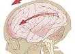 How to Recognise a Concussion Headache