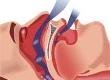 Sleep Apnea and Morning Headaches